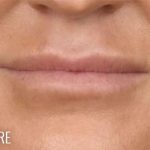 Lip Lift Before & After Patient #967