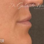 Lip Lift Before & After Patient #967