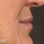Lip Lift Before & After Patient #967