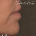 Lip Lift Before & After Patient #960