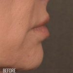 Lip Lift Before & After Patient #960