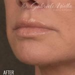 Lip Lift Before & After Patient #960