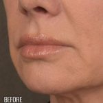 Lip Lift Before & After Patient #960