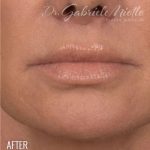 Lip Lift Before & After Patient #960