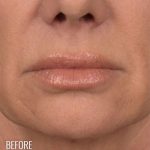 Lip Lift Before & After Patient #960