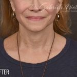 Facelift Before & After Patient #875