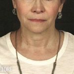Facelift Before & After Patient #875