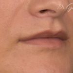 Lip Lift Before & After Patient #889
