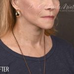 Facelift Before & After Patient #875