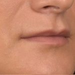 Lip Lift Before & After Patient #889