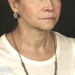 Facelift Before & After Patient #875