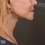 Facelift Before & After Patient #875