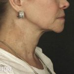 Facelift Before & After Patient #875