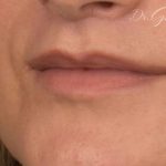 Lip Lift Before & After Patient #889