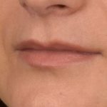 Lip Lift Before & After Patient #889