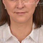 Facelift Before & After Patient #874