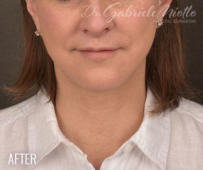 Facelift Before & After Patient #874