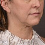 Facelift Before & After Patient #874