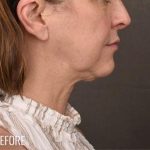 Facelift Before & After Patient #874