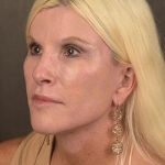 Facelift Before & After Patient #873
