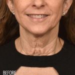 Neck Lift Before & After Patient #979