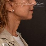 Neck Lift Before & After Patient #979