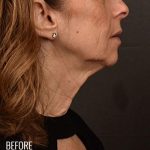 Neck Lift Before & After Patient #979