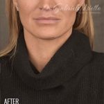 Facelift Before & After Patient #870