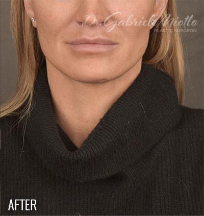 Facelift Before & After Patient #870