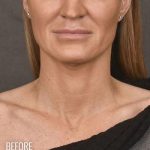 Facelift Before & After Patient #870