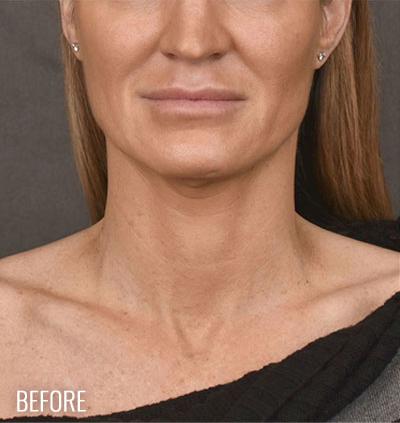 Facelift Before & After Patient #870