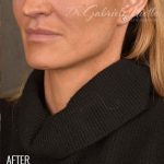 Facelift Before & After Patient #870