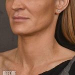 Facelift Before & After Patient #870