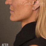 Facelift Before & After Patient #870