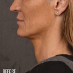 Facelift Before & After Patient #870