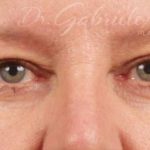 Blepharoplasty Before & After Patient #708