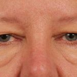 Blepharoplasty Before & After Patient #708