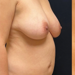 Breast Lift With Implants Before & After Patient #1700