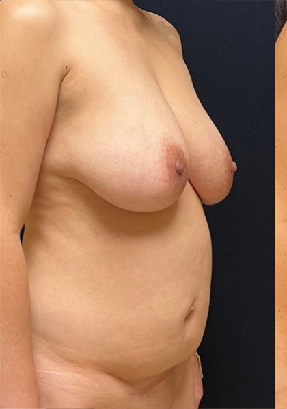 Breast Lift With Implants Before & After Patient #1700