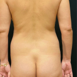 Breast Lift With Implants Before & After Patient #1700
