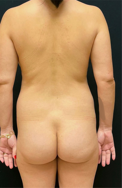 Breast Lift With Implants Before & After Patient #1700