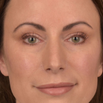 Facial Fat Grafting Before & After Patient #1250