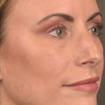 Facial Fat Grafting Before & After Patient #1250