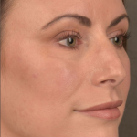 Facial Fat Grafting Before & After Patient #1250