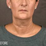 Facelift Before & After Patient #868