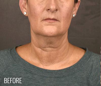 Facelift Before & After Patient #868