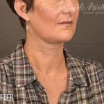 Facelift Before & After Patient #868