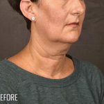 Facelift Before & After Patient #868