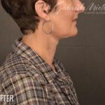 Facelift Before & After Patient #868
