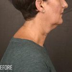 Facelift Before & After Patient #868